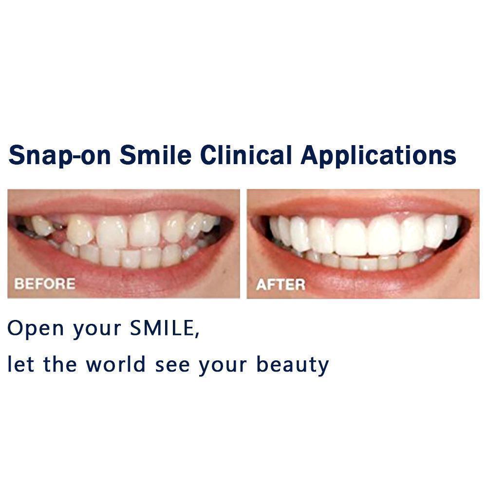 1 SET OF DIAMOND SMILE VENEERS (TOP & BOTTOM TEETH)