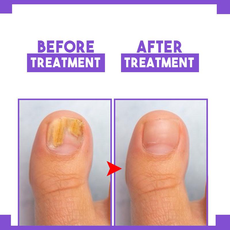 Nail Restoration Pen