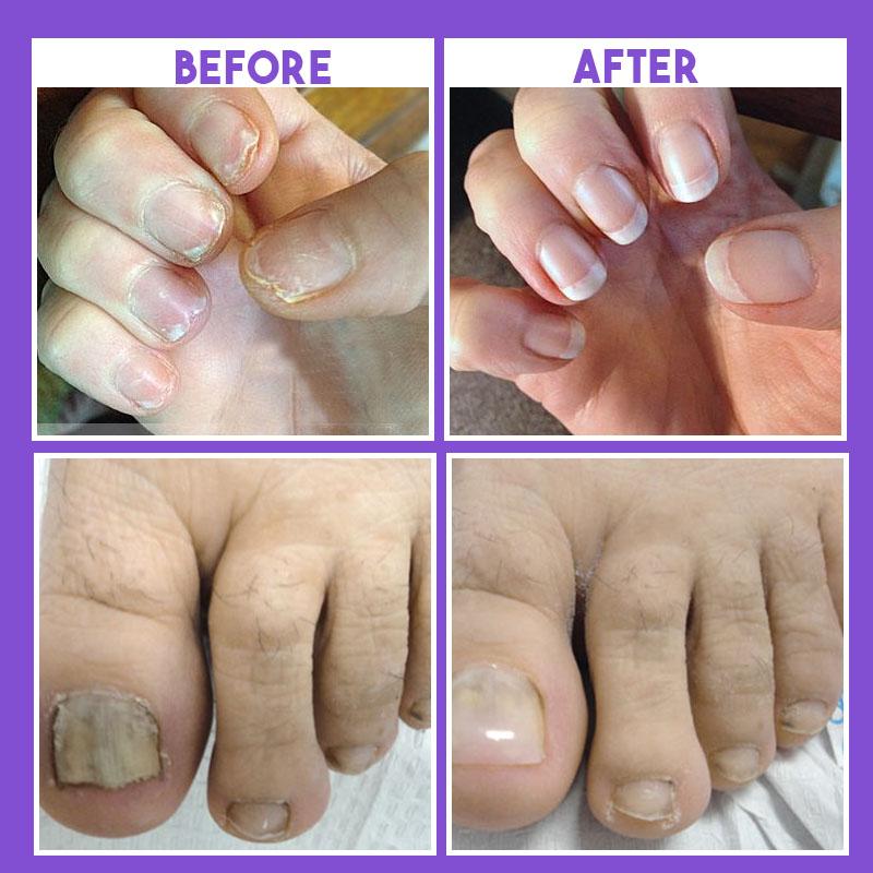 Nail Restoration Pen